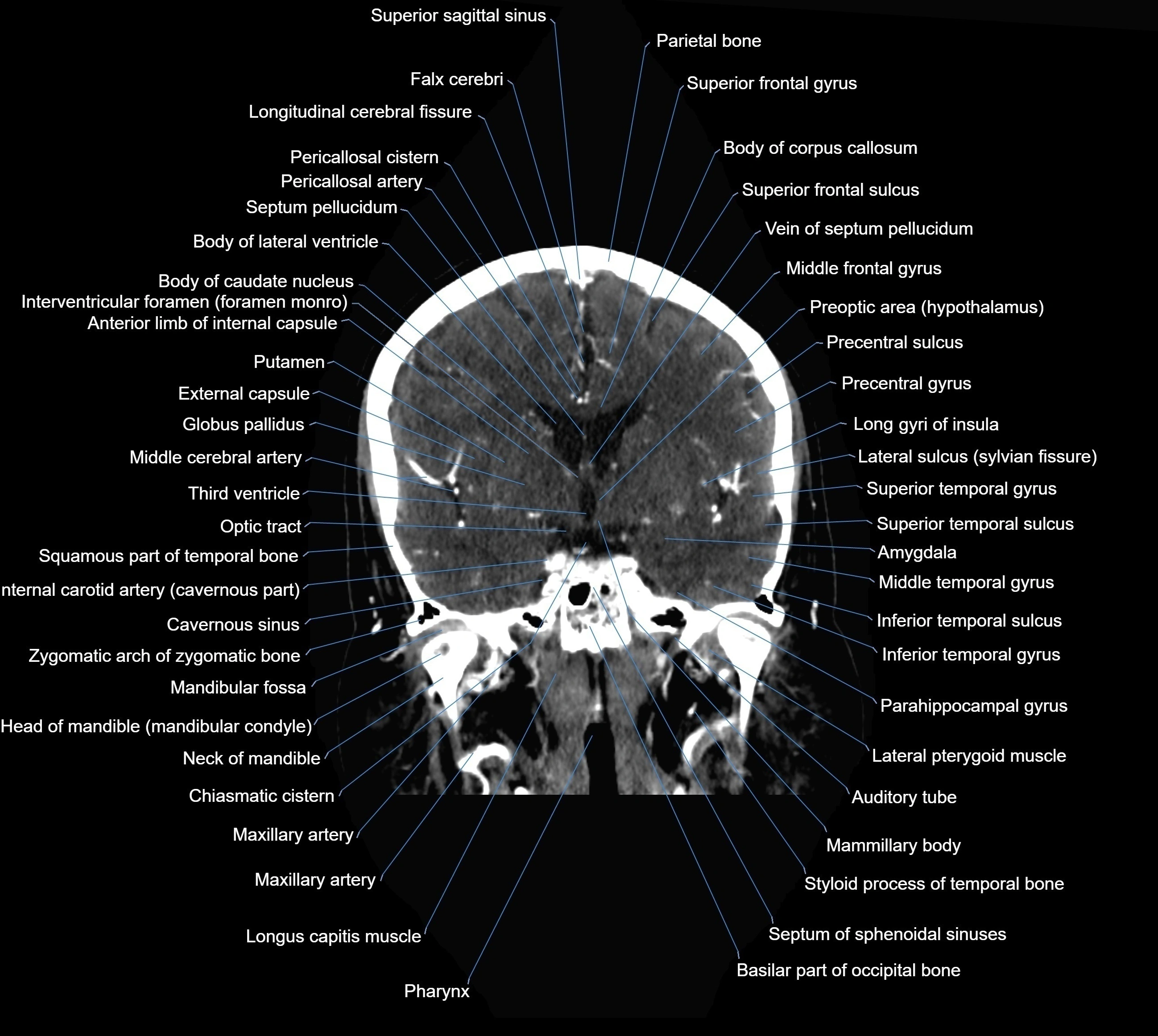 CT Brain coronal cross sectional radiology anatomy image  -img-00001-022.webp